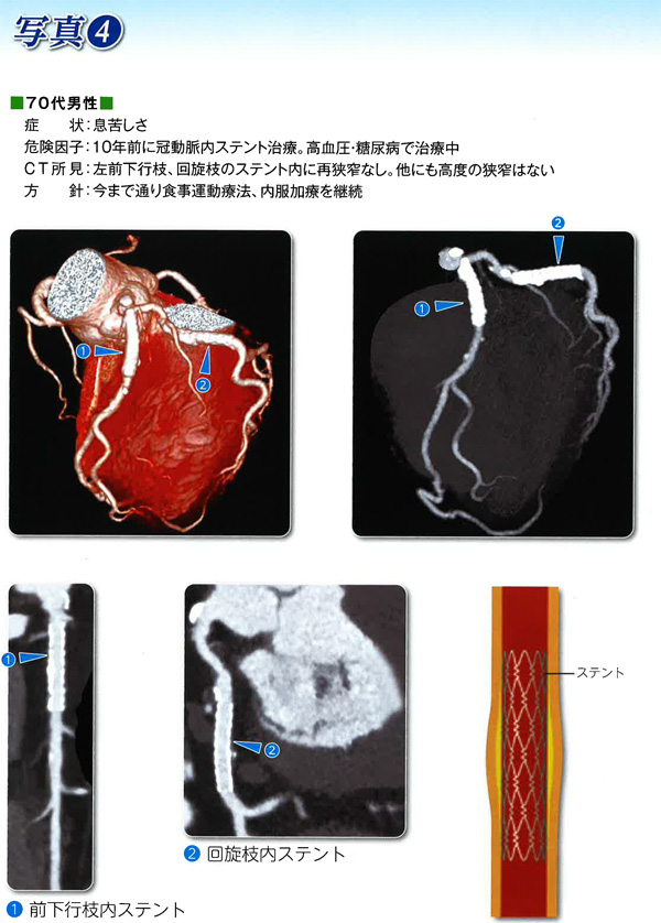 心臓CT検査