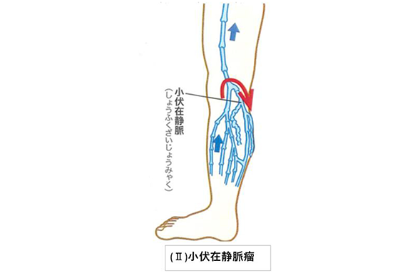 （II）小伏在静脈瘤