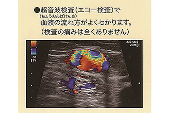 （5）下肢静脈瘤の診療、検査